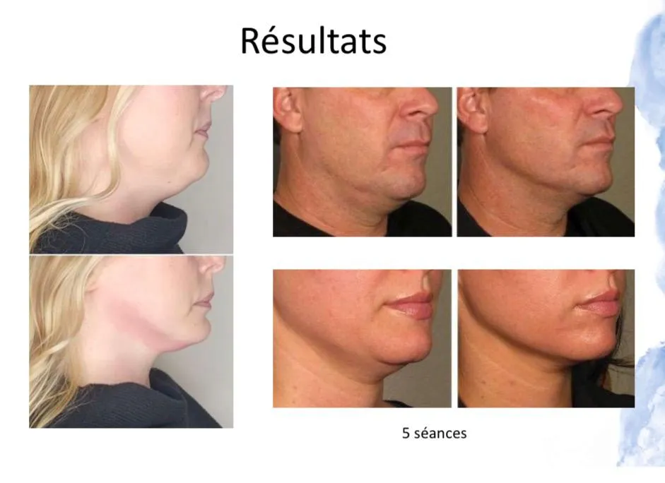 Résultats avant-après d’un traitement de cryothérapie esthétique au niveau du visage et du cou